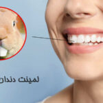لمینت دندان خرگوشی