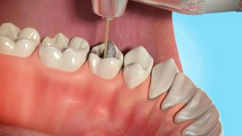 روت کانال تراپی یا درمان ریشه دندان