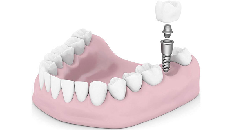 کاشت ایمپلنت دندان