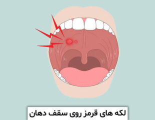 لکه های قرمز روی سقف دهان