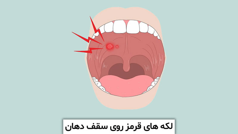 لکه های قرمز روی سقف دهان