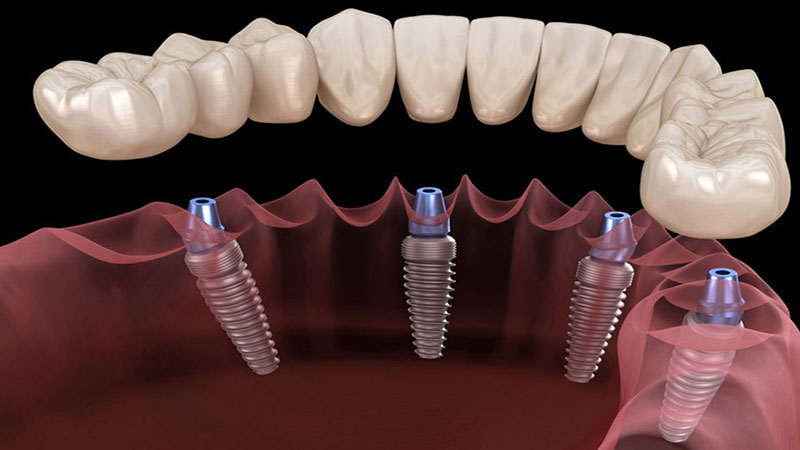 مراحل ایمپلنت دندانی