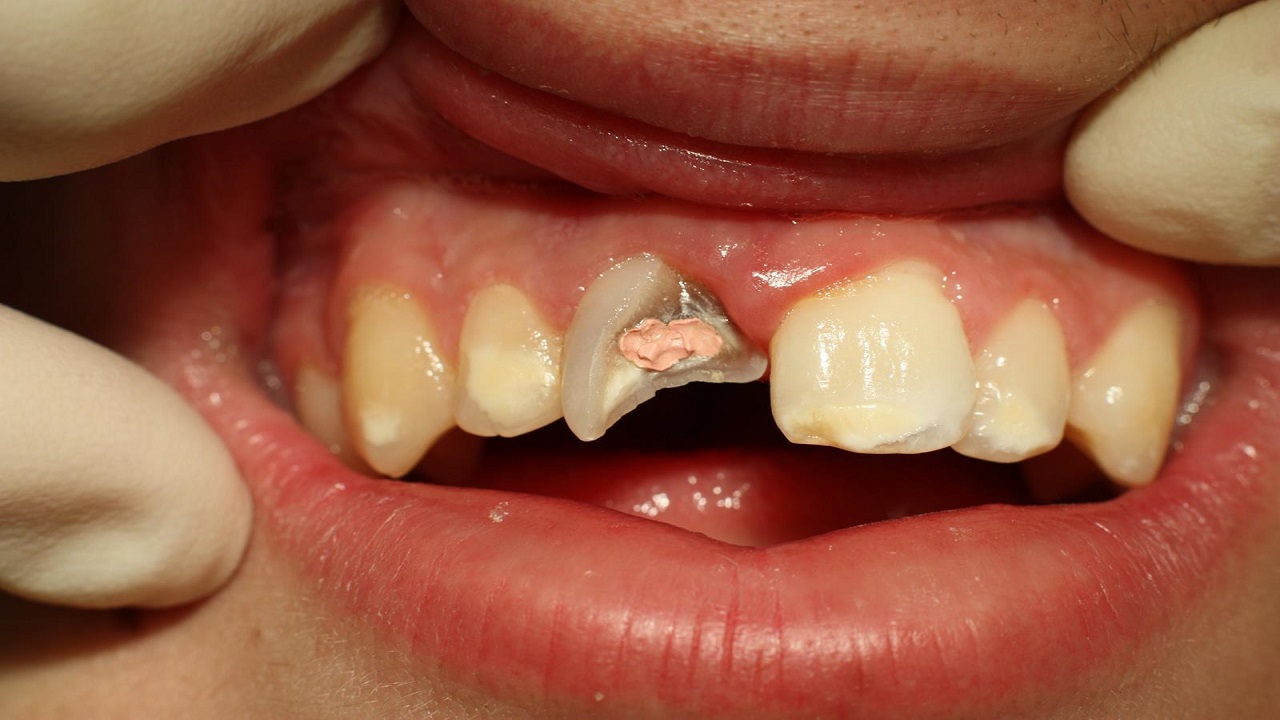 دلایل شکستن دندان-پوسیدگی دندان