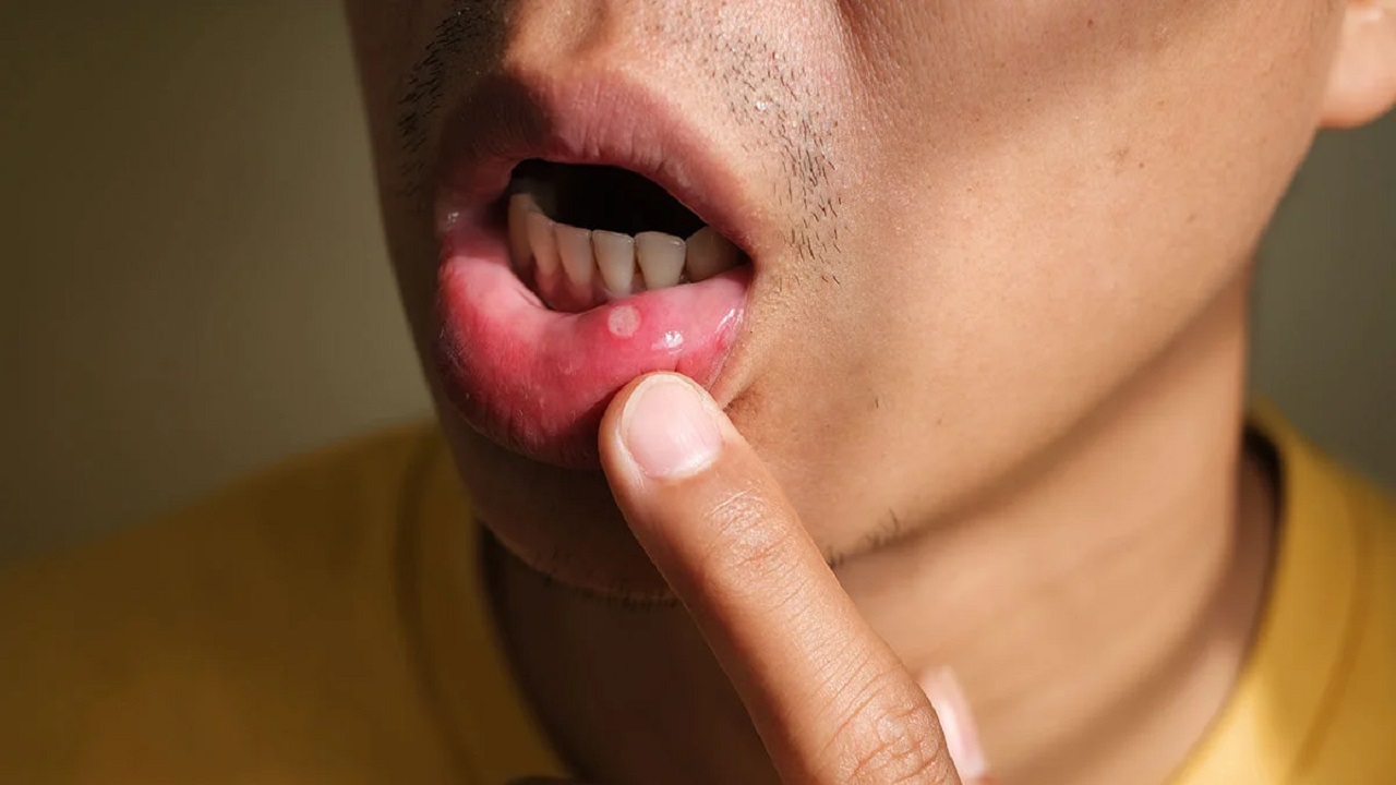 سرطان های بافت مخاطی دهان