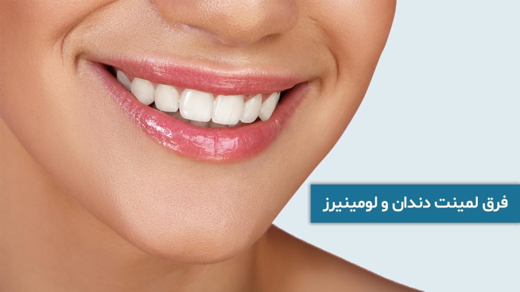 فرق لمینت دندان و لومینیرز