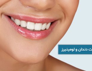 فرق لمینت دندان و لومینیرز