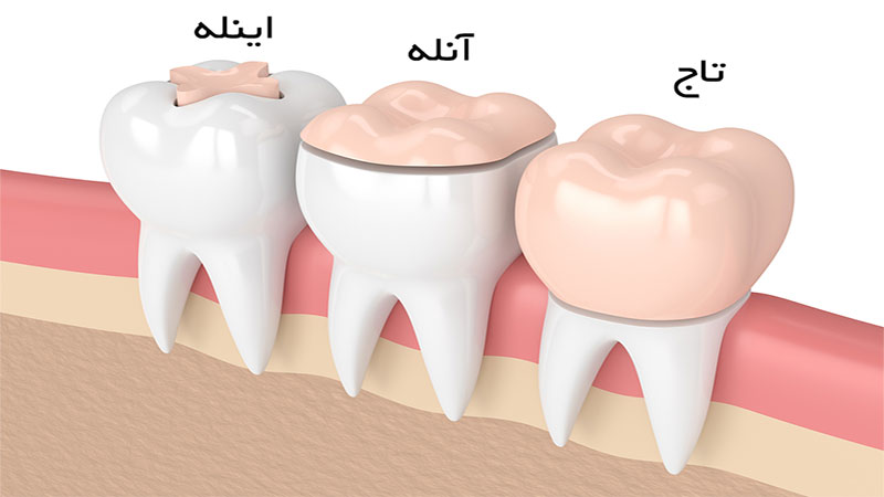 اینله و آنله دندان